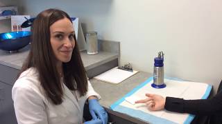 Wart Removal Using Liquid Nitrogen [upl. by Aleekat]