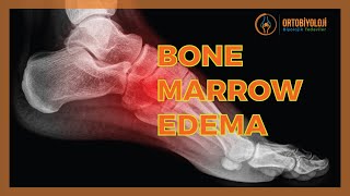 BONE MARROW EDEMA TREATMENTS [upl. by Howarth513]