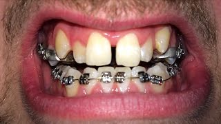 FULL BRACES TIME LAPSE [upl. by Medlin181]