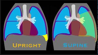 Pleural Effusion Explained by Prometheus Lionhart MD [upl. by Justina]