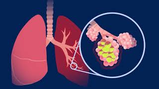 Understanding Pneumococcal Pneumonia [upl. by Nierman536]