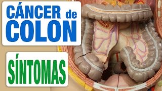 Cáncer de Colon  Síntomas [upl. by Enirehtac]