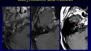 Temporal Bone Pathology 6 Hearing Loss Part 1 [upl. by Hike912]