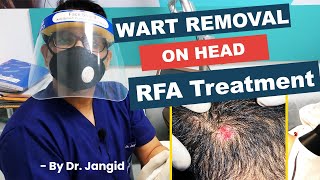 Wart Removal on Head  Live RFA Wart Removal Treatment  Dr Jangid [upl. by Marilin435]