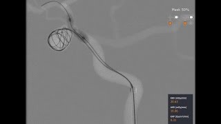 Mentice Neurovascular Brain Aneurysm Coiling Demo [upl. by Inig]