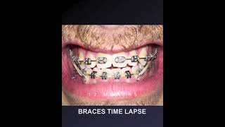 braces time lapse [upl. by Anerev]