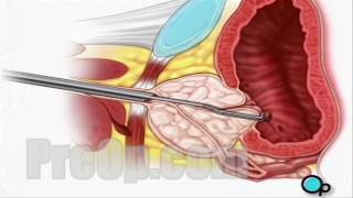 TURP Transurethral Resection Prostate Surgery patient education series [upl. by Nnairret]