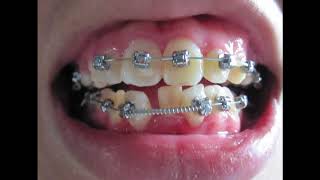 Braces  Before and After Time Lapse [upl. by Eddra]