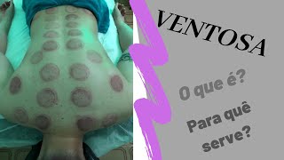 ⚫Ventosaterapia  o que é e para quê serve [upl. by Behre138]