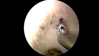 Shocking Moment Doctor Removes Live Tick From Ear Canal [upl. by Hatch606]