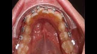 Crooked teeth braces lower jaw time lapse [upl. by Lowrie]