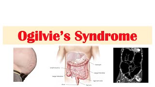 Ogilvie Syndrome  PseudoObstruction of the Large Intestine Causes Symptoms Diagnosis Treatment [upl. by Dollar]