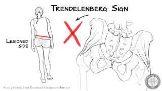 The Trendelenberg Sign HD [upl. by Champ722]