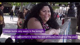 What is vitiligo [upl. by Mauricio]