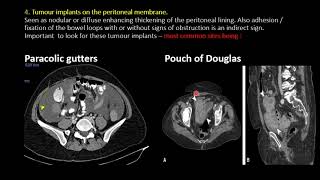 Imaging in Peritoneal Carcinomatosis [upl. by Ttam799]