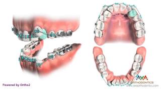 Orthodontic Treatment for Severe Crowding  Removing 4 Premolars [upl. by Hairym]