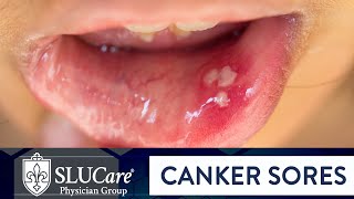 Determining Causes amp Treatment for Canker Sores  SLUCare Otolaryngology [upl. by Quartus]