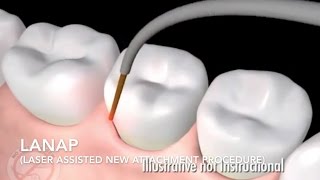 How Does Laser Surgery Work Treat Gum Disease  LANAP [upl. by Yared]