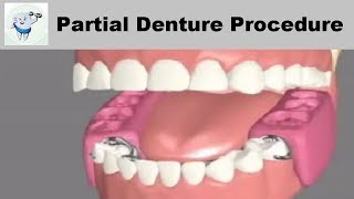 Removable Partial Dentures Steps [upl. by Ioyal348]