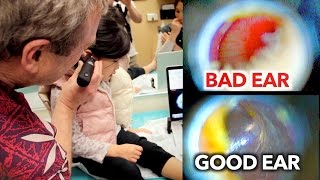 EAR INFECTION vs PERFECT EAR Inside Look  Dr Paul [upl. by Millard]