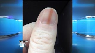 Melanoma on Your Nail [upl. by Eelrihs]