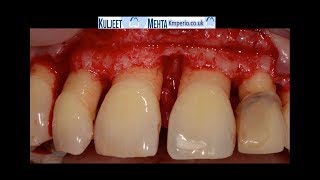 Periodontal Surgery Upper Front Teeth [upl. by Rennoc]