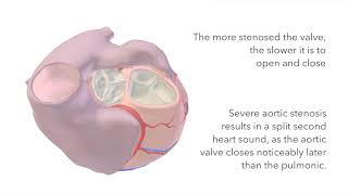 Aortic Stenosis  Murmur Sound amp Animation [upl. by Nahtanoy]