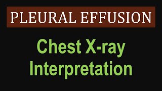 Pleural Effusion  Chest Xray Interpretation [upl. by Susanna]