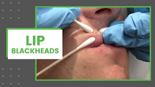 Lip Blackheads  Dr Derm [upl. by Attenborough886]