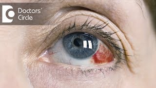 Causes of red clots in eyes  Dr Mala Suresh [upl. by Adnaram]