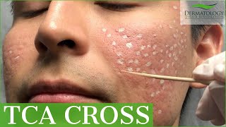 Acne Scar Removal with TCA Cross 80  Los Angeles  Dr Ben Behnam [upl. by Hussein]