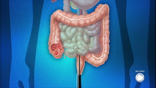 Você e o Doutor saiba tudo sobre os males do intestino [upl. by Ennasirk319]