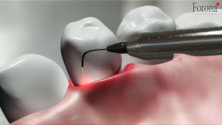 TwinLight® Periodontal Treatment [upl. by Gagliano]