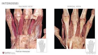 Anatomy of the Upper Limb Interossei and Lumbricals [upl. by Calli]