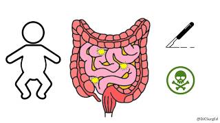 Necrotizing Enterocolitis [upl. by Jayne903]