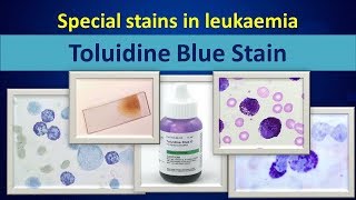 Toluidine blueSpecial stain in leukaemia [upl. by Morrison454]