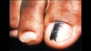 Are Black Toenail Lines amp Streaks Safe Doctor Treatment [upl. by Karissa]