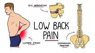 Low Back Pain Explained Including Red Flags [upl. by Fish]