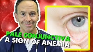 Pale Conjunctiva  A Sign of Anemia [upl. by Azer]