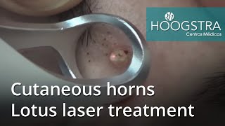 Cutaneous horns  Lotus laser treatment 20233 [upl. by Aitan]