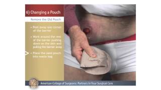 ColostomyIleostomy Changing a Pouch [upl. by Aneeuqal121]