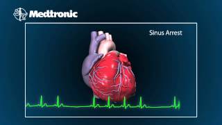 What Is Bradycardia [upl. by Magbie488]