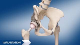 Hüft TEP  Individuelles künstliches Hüftgelenk Animation [upl. by Nahshu]