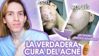 ROACCUTAN o ACCUTANE Efectos adversos como tomarla antes y despues LA VERDAD de la ISOTRETINOINA [upl. by Andert343]