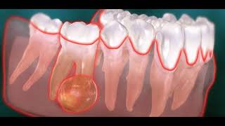 Abcès endodontique dentaire kyste [upl. by Hurst687]