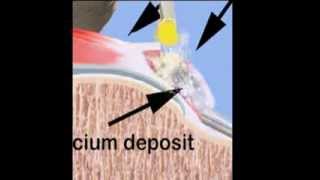 Calcium Removal [upl. by Matusow]