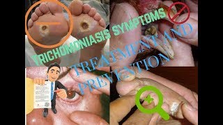 Trichomoniasis symptomsTreatment and Prevention [upl. by Schaefer]