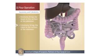 ColostomyIleostomy Your Operation [upl. by Karee295]