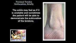 Peroneal Tendon Subluxation Briefly  Everything You Need To Know  Dr Nabil Ebraheim [upl. by Yorgo496]