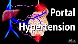 Portal Hypertension Animation [upl. by Niatsirhc]